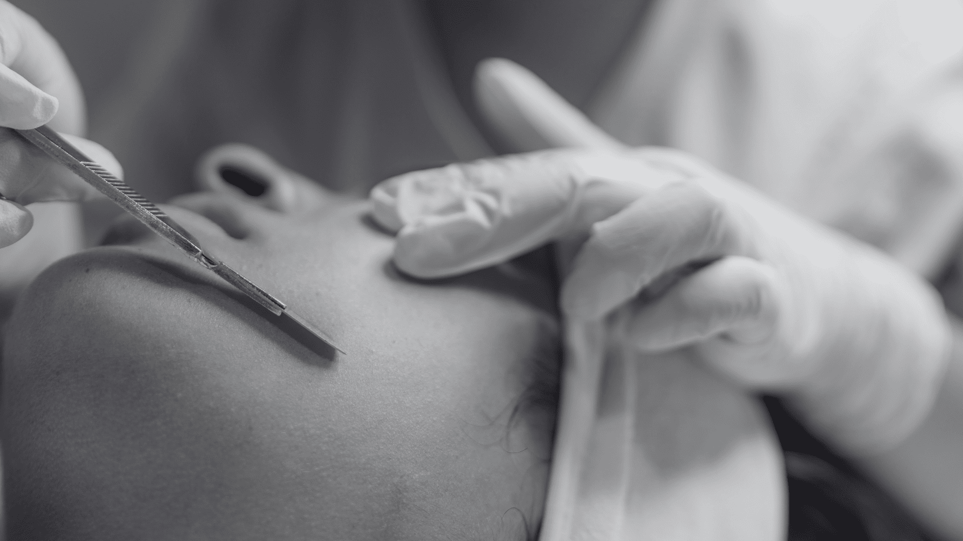 A professional facial treatment in progress with a scalpel and gloved hands on a person's face.