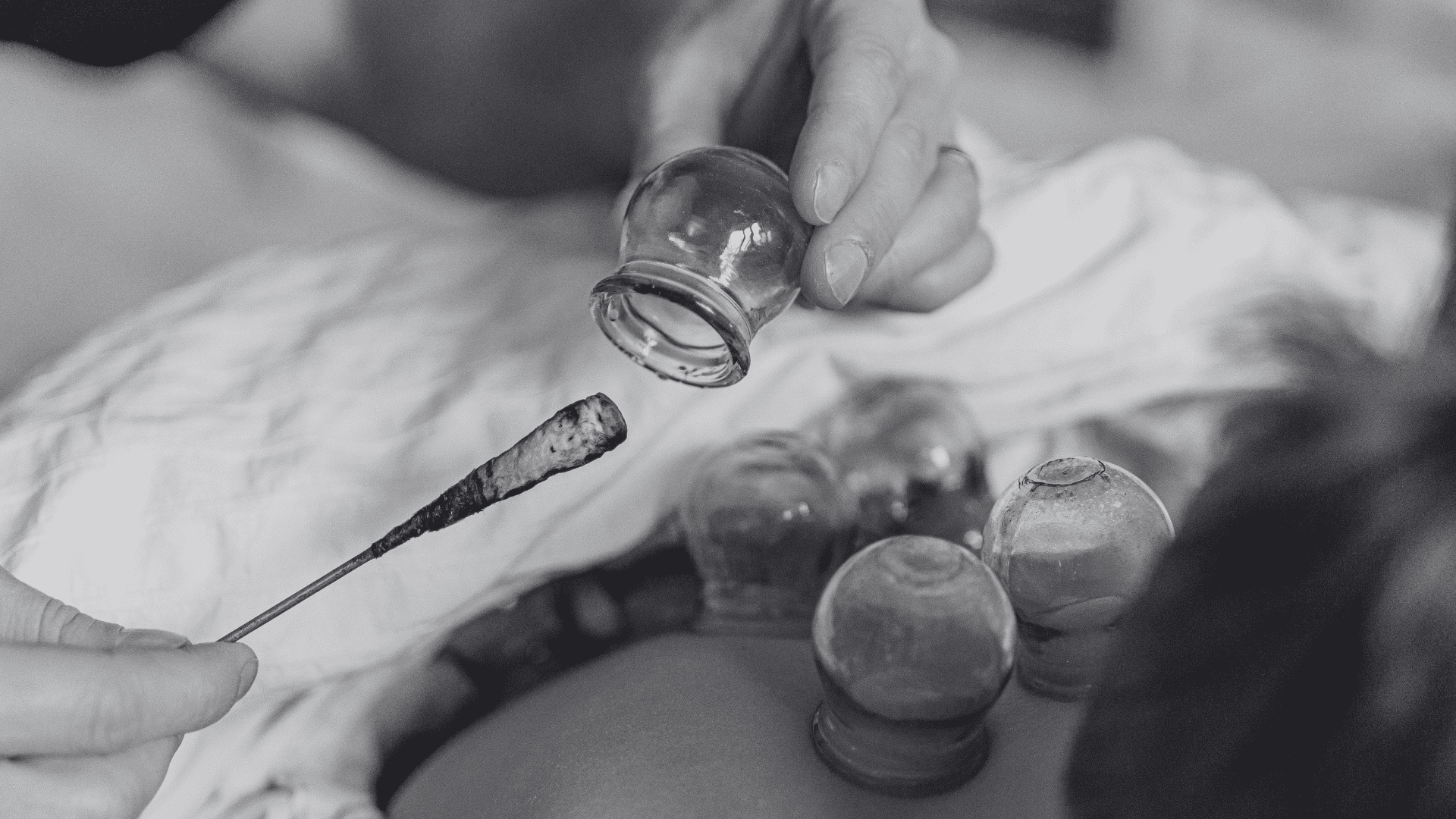Cupping therapy procedure with glass cups on a person's back, therapist holding a lit stick.
